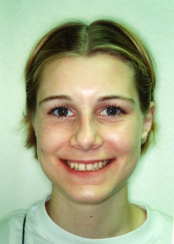 After orthodontics image of a girl at Gary R. Templeman, DDS. 