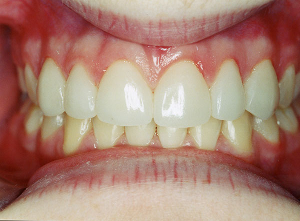 After veneers front teeth of a girl at Gary R. Templeman, DDS. 