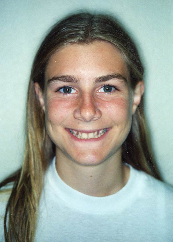Before orthodontics image of a girl at Gary R. Templeman, DDS. 